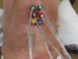 کتتر براکی تراپی