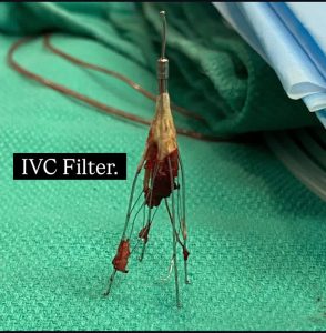 فیلتر IVC