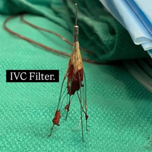 فیلتر IVC